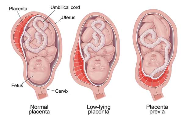 پاورپوینت دکولمان و پرویا